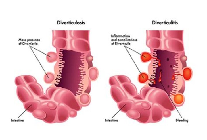 Is diverticular disease an inflammatory bowel disease?