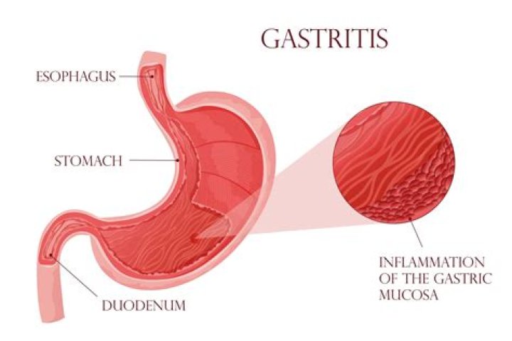 Is gastropathy a medical term?
