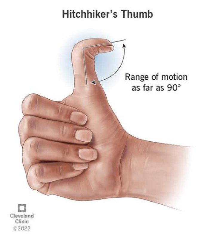 Is hitchhiker's thumb normal?