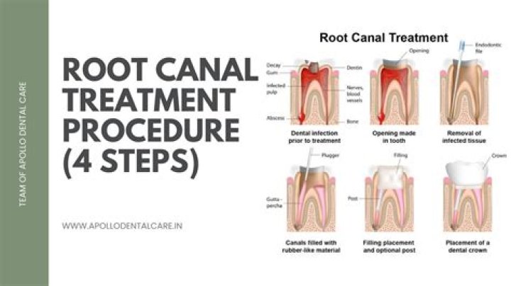 Is re root canal treatment safe?