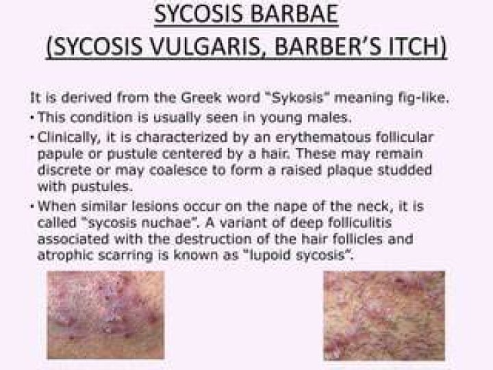 Is sycosis a word?
