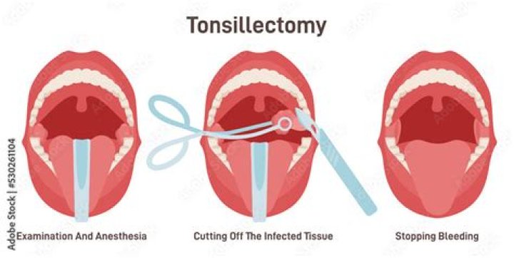 Is tonsillectomy worth it?