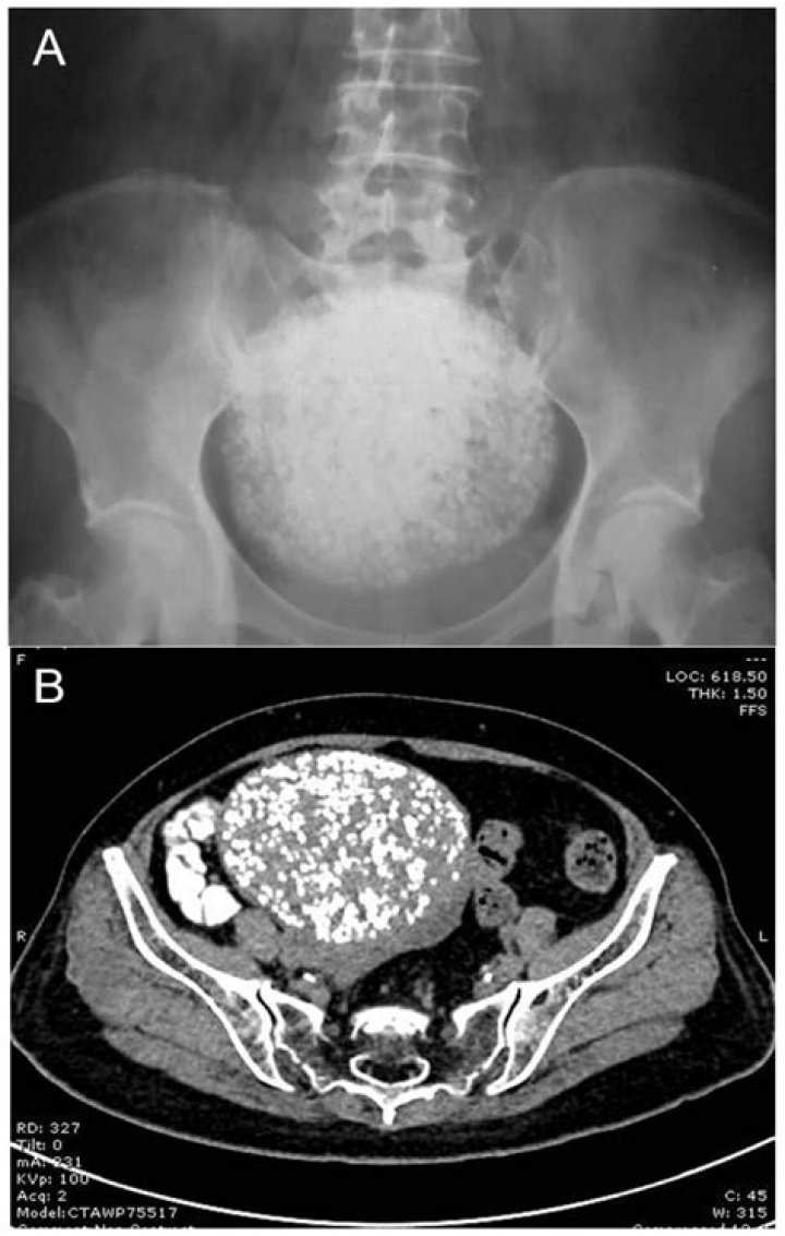 Is uterine leiomyoma dangerous?