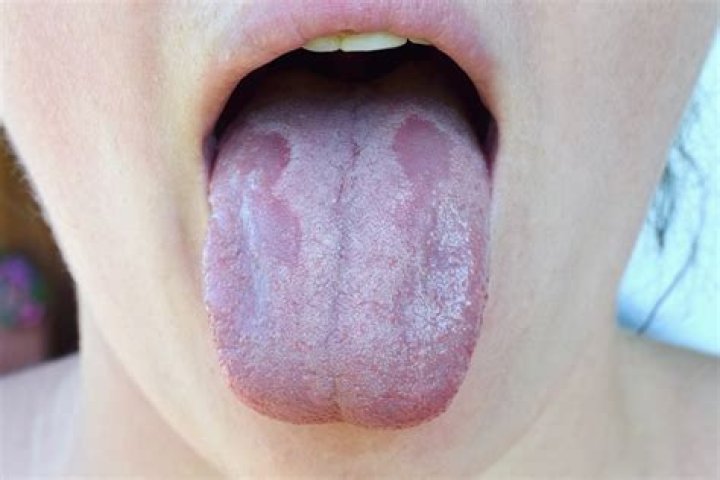 Is white tongue dehydration?
