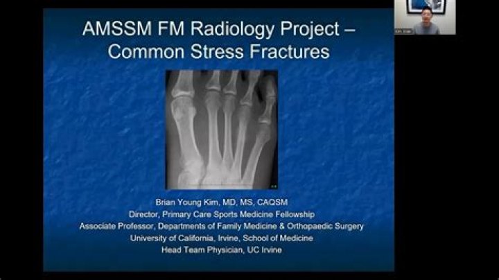 Should a stress fracture be casted?