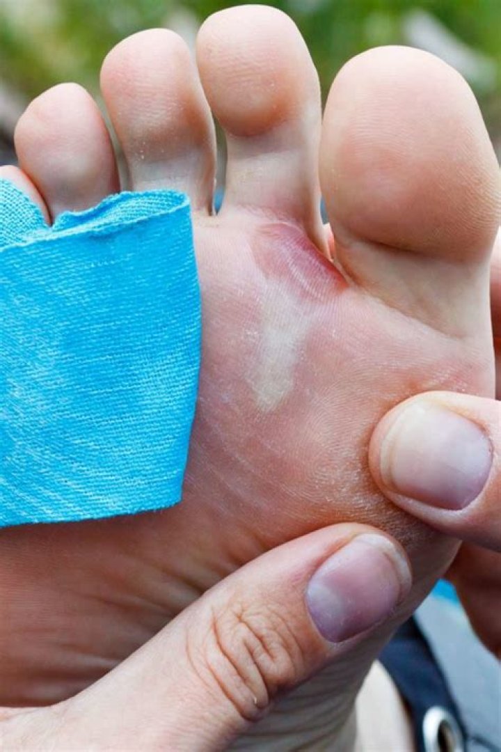 Should i pop a blister full of blood?