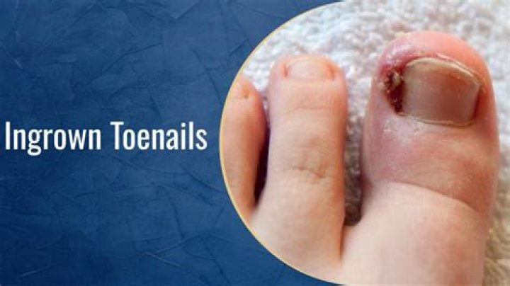 Should i remove detached toenail?