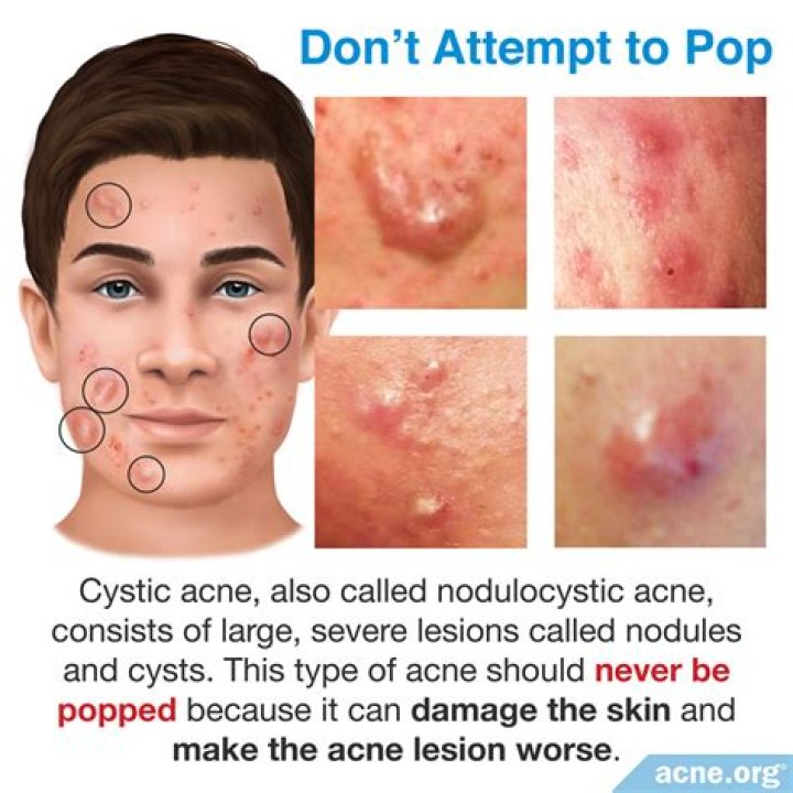 Should you pop cystic acne?