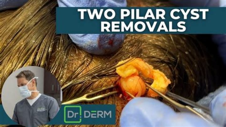 Should you remove pilar cysts?