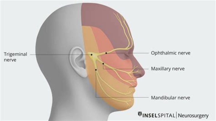 Was ist trigeminal neuralgia?