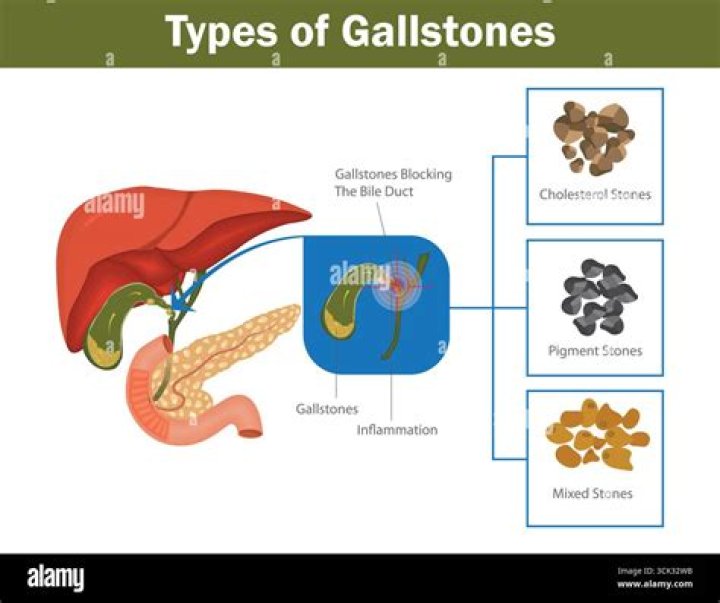 What are gallstones made of?