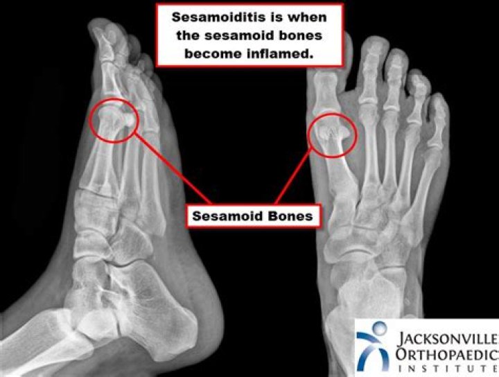 What are sesamoid bones and where are they located?