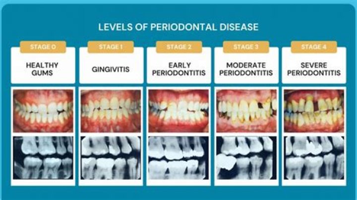 What are the main causes of periodontal disease?