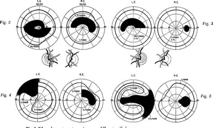 What causes arcuate scotoma?