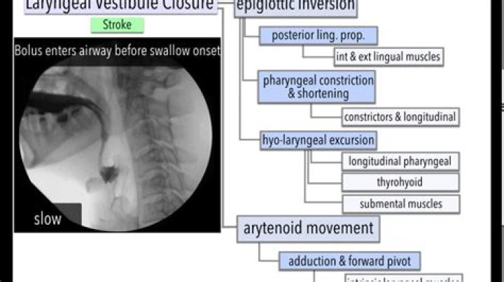 What causes epiglottic inversion?