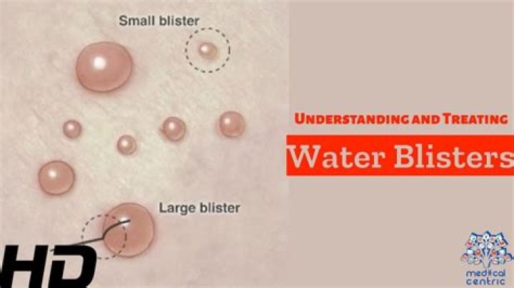 What causes water blisters?