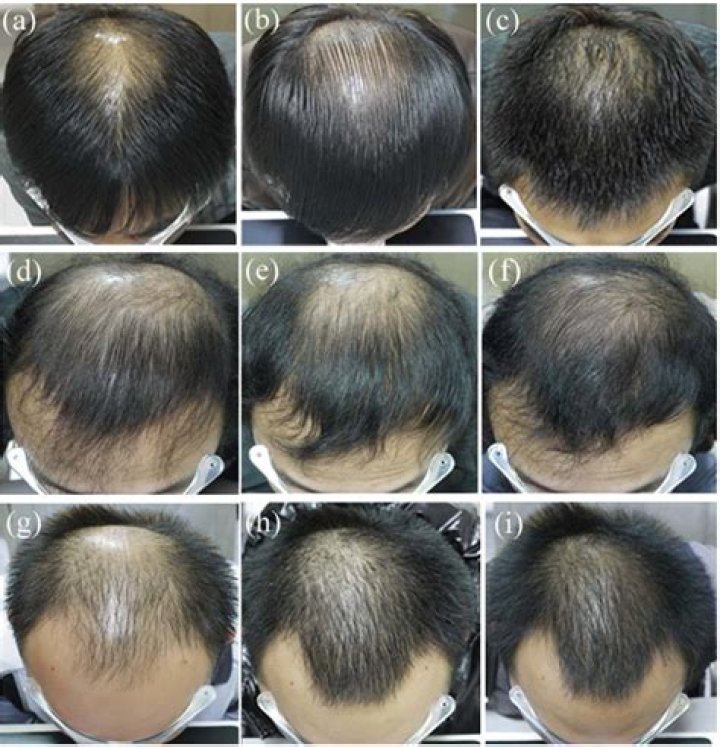 What do you mean by finasteride?