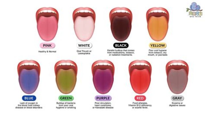 What does a discoloured tongue mean?