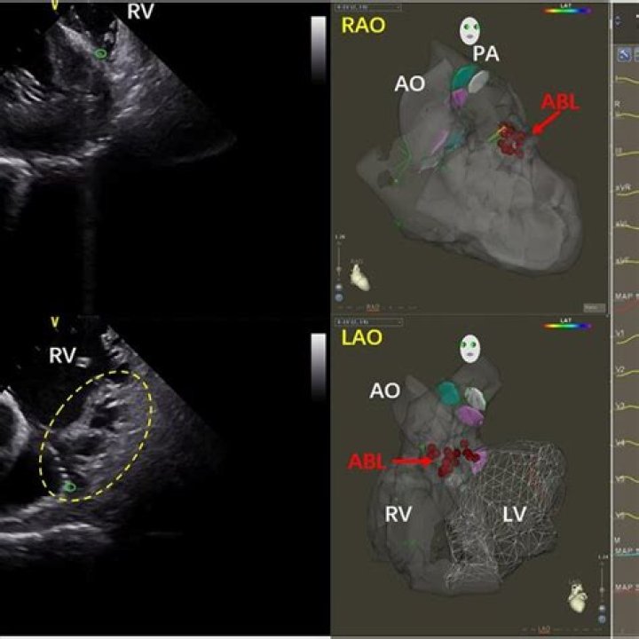What does inferoanterior mean?