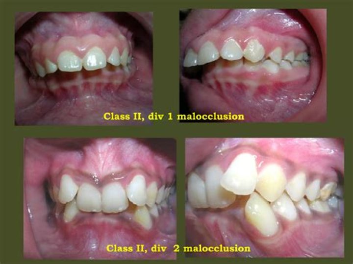 What is a class ii malocclusion?