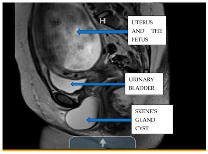 What is a periurethral cyst?