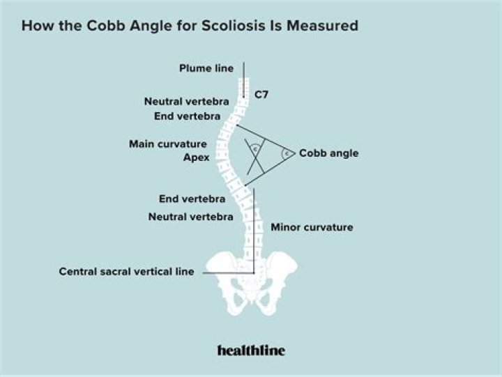 What is cobb angle?