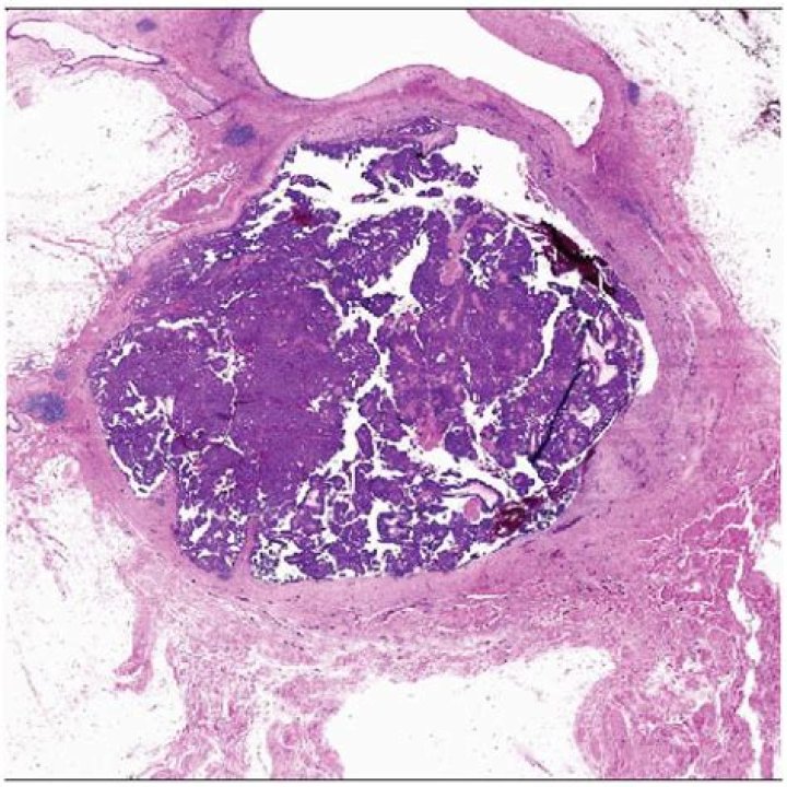 What is encysted papillary carcinoma?