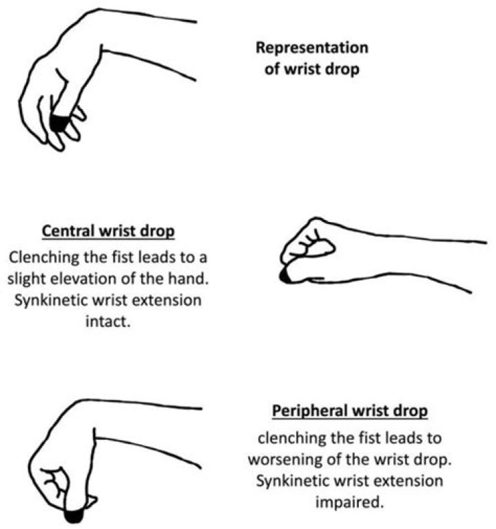 What is meant by synkinetic?