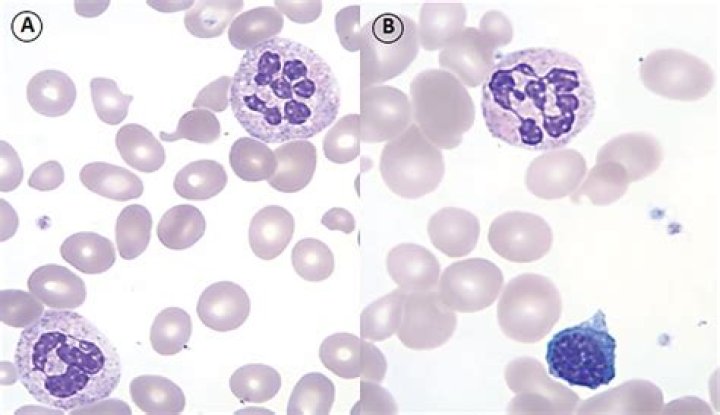What is megaloblastic change?