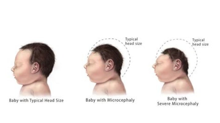 What is microcephaly-lissencephaly syndrome?