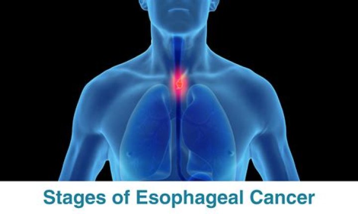 What is precancerous esophagus?