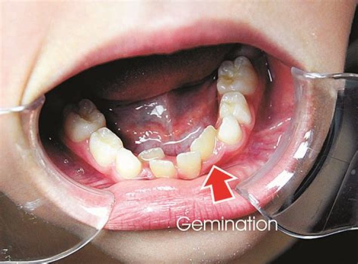 What is the meaning of gemination?