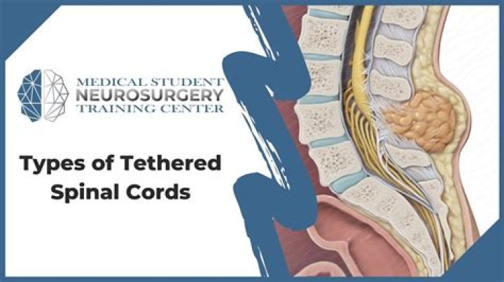 What is untethering of spinal cord?