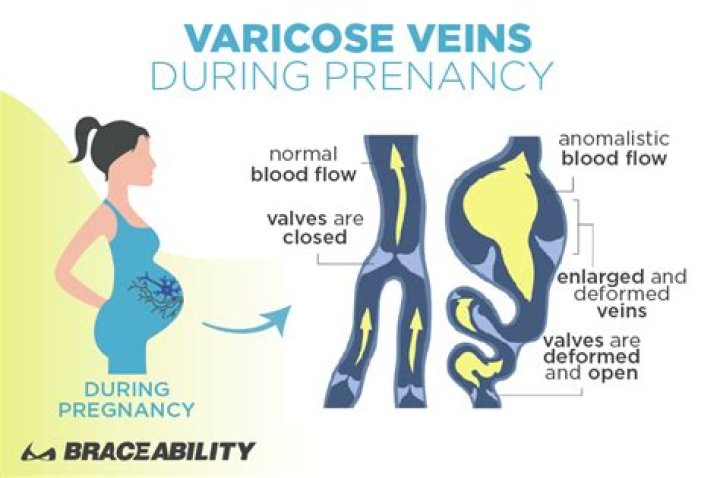 What is vulvar varicosities?