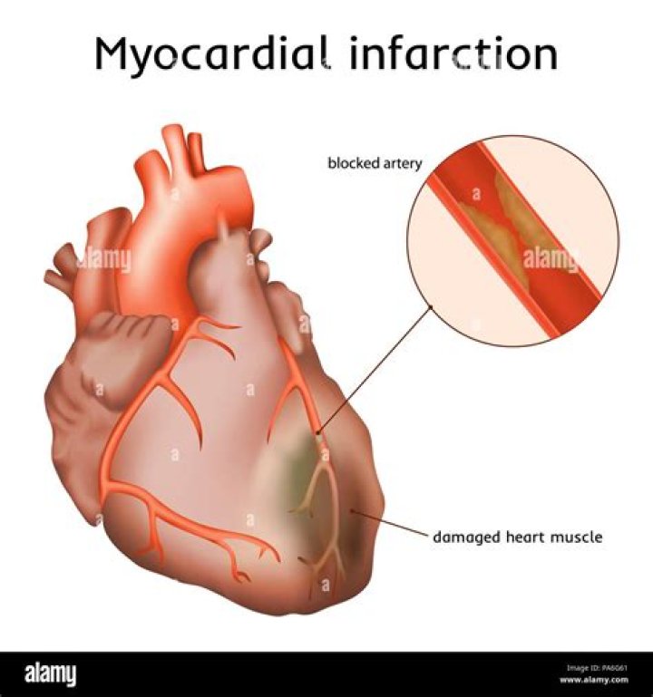 What myocardial injury means?