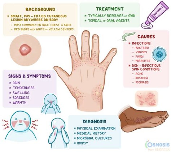 When do pustules go away?