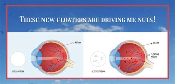 When i squint my eyes i see floaters?