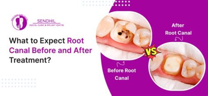 When to stop eating before a root canal?