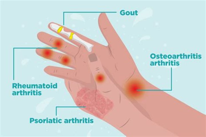 Where arthritis come from?