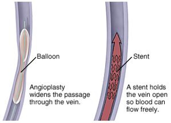 Where can angioplasty be found?