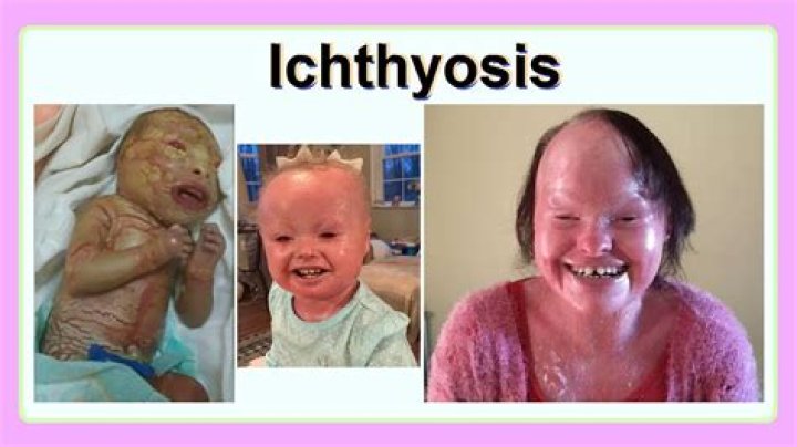 Where did ichthyosis originate?