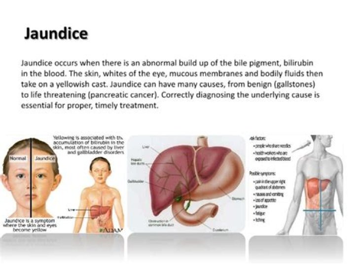 Where did the word jaundice come from?