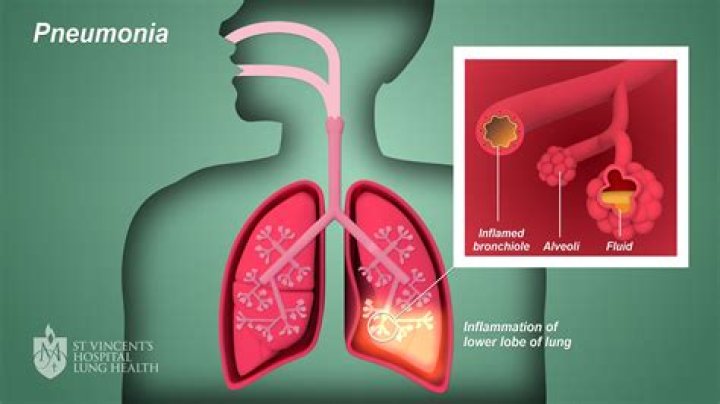 Where does pneumonia occur?