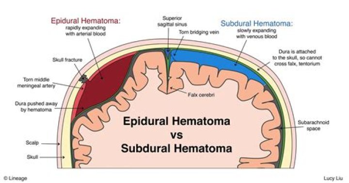 Where is subdural hematomas?