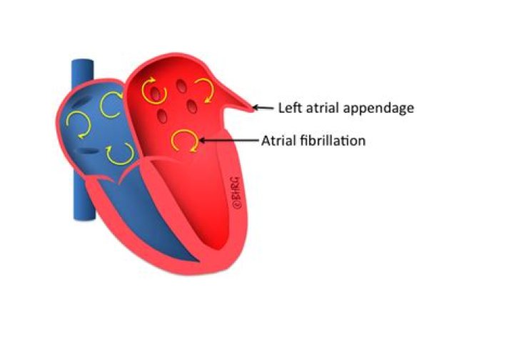 Where is the atrial appendage?