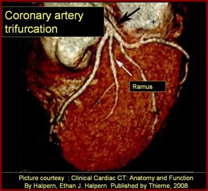 Where is the ramus coronary artery?