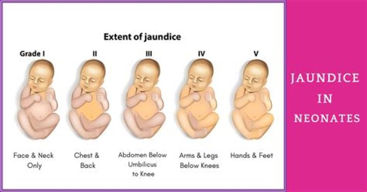 Where to examine jaundice?
