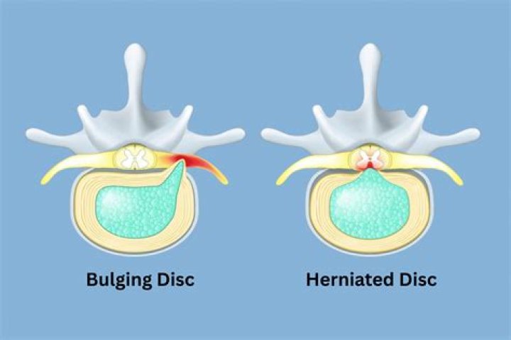 Which is worse herniated disc or bulging disc?