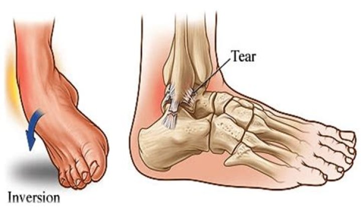 Which is worse sprained ankle or fracture?