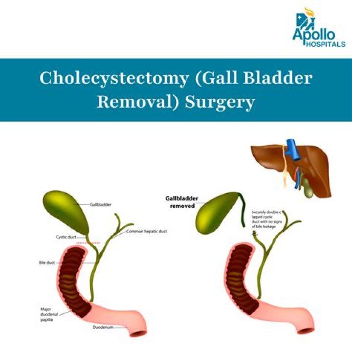 Which structures must be ligated during cholecystectomy?